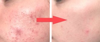 10 Natural Cystic Acne Treatments That Really Work
