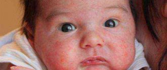 аллергический дерматит на лице у ребенка