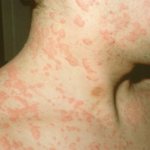 allergy red spots photo