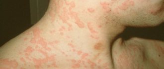аллергия красные пятна фото