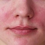 Аллергия на лице девушки
