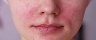 Аллергия на лице девушки