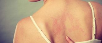 Аллергия у детей, фото различной сыпи на теле, лице и спине