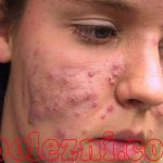What is acne on the face - photos and videos