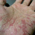 Hand dyshidrosis and dyshidrotic eczema