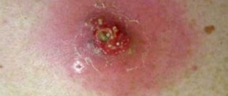 single purulent inflammation on the skin (abscess), photo