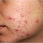 Photo 1 - Pimples ruin your appearance