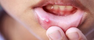 Герпес во рту встречается часто и способен поражать губы, область подбородка и слизистую рта