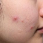 Purulent pimple on the face