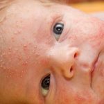 Hormonal rash on the face of an infant