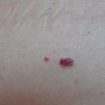 How to get rid of red moles