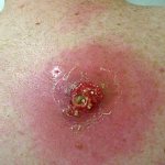 What does a boil look like in the abscess stage?