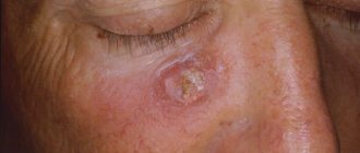 Keratopapilloma on the skin