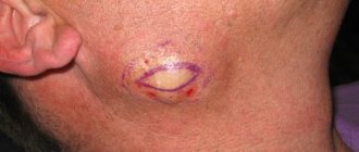 Sebaceous cyst on the neck