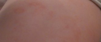 Brown spots on a child&#39;s back