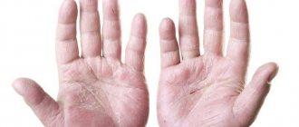Кожа на пальцах рук сохнет и трескается: причины и методы лечения