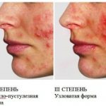 Кожные заболевания на лице. Признаки, фото и описание симптомов у взрослых и детей