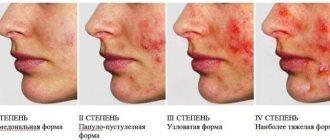 Кожные заболевания на лице. Признаки, фото и описание симптомов у взрослых и детей
