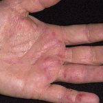 skin diseases on the hands
