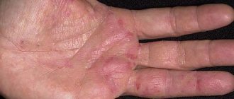 кожные заболевания на руках