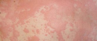 Urticaria on the skin of an adult