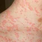 red rash on the skin