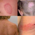 ringworm or allergies in a child