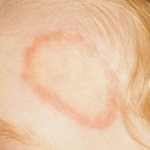 Ringworm on a child&#39;s forehead.