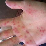 мазь от аллергии на холод на руках