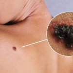 Melanoma is a threat to life