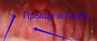 pimples on the tonsils