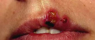 na gubah - Red pimples in the mouth in adults