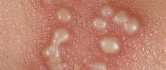 Watery pimples on the penis