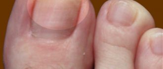 Начальная стадия грибка ногтей