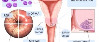 Опасен ли вирус папилломы человека у женщин в гинекологии