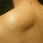 Differences between lipoma and atheroma: how to determine which tumor is on the body?