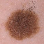 We answer the questions: why does hair form on a mole and is it possible to pull it out?