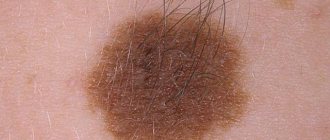 We answer the questions: why does hair form on a mole and is it possible to pull it out?