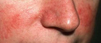 Why does your nose turn red in the cold?