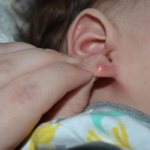 Почему появился шарик в мочке уха? Лучшие советы, как убрать воспаление и шишку внутри