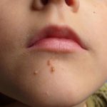 Why do papillomas appear in children?