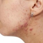 Why do women get acne on their necks?