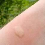 Why are there blisters on the body?