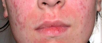 Subcutaneous acne on the face