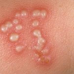 Let&#39;s talk about home methods for treating herpes manifestations...