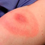 Let&#39;s talk about how the body&#39;s allergic reaction to insect bites can manifest itself, as well as what danger this can pose in some cases...