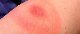 Let&#39;s talk about how the body&#39;s allergic reaction to insect bites can manifest itself, as well as what danger this can pose in some cases...