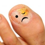 Causes and symptoms of nail fungus