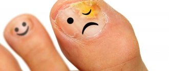 Причины и симптомы грибка ногтей