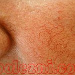 Signs and treatment of rosacea in the photo